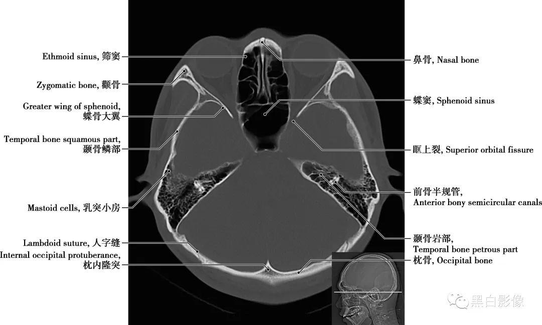 颅底ct断层解剖骨窗图片