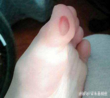 长途骑行中脚上磨出了水泡怎么处理摩擦性水泡这样处理很危险