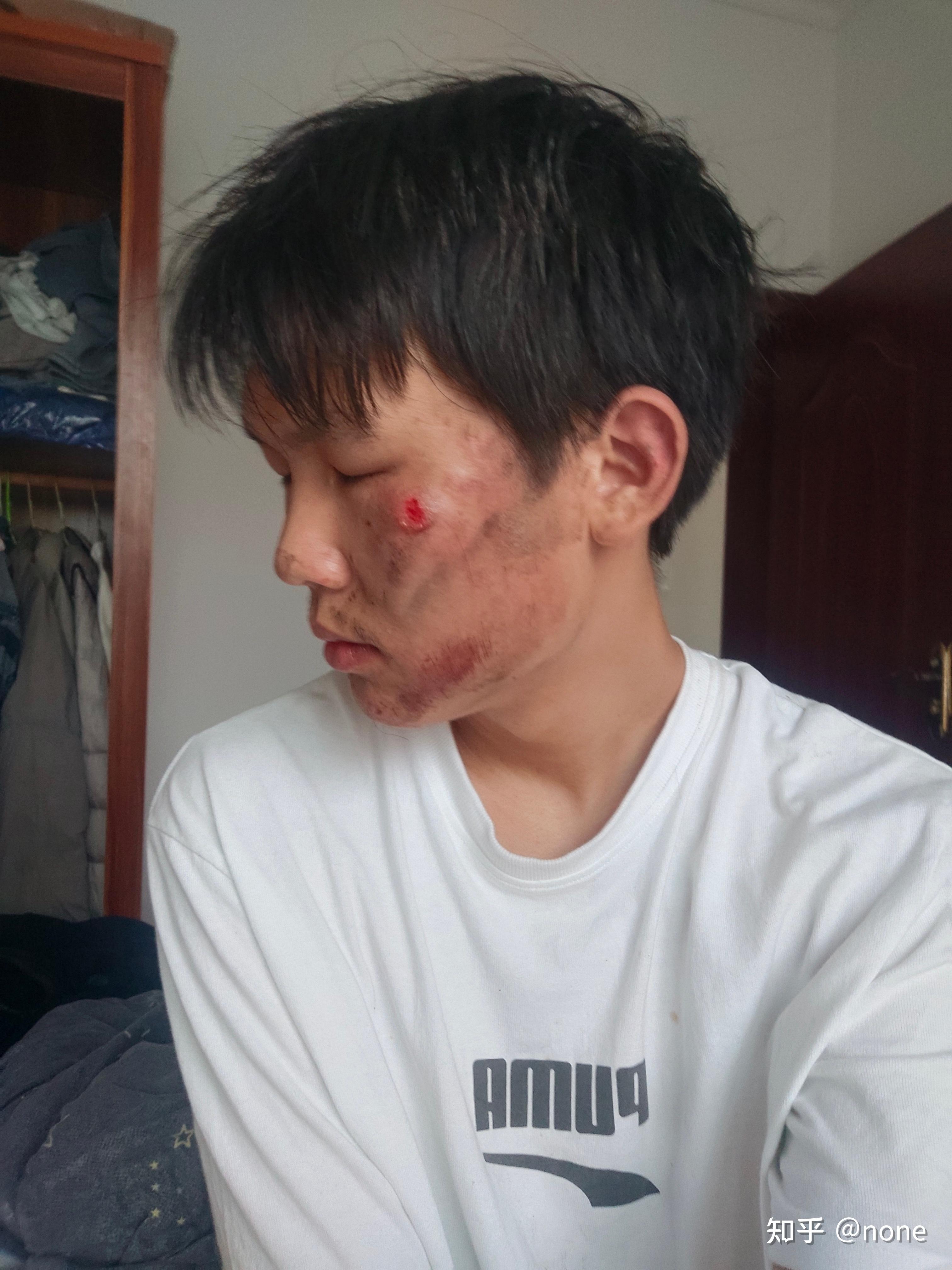 记录脸部擦伤恢复过程