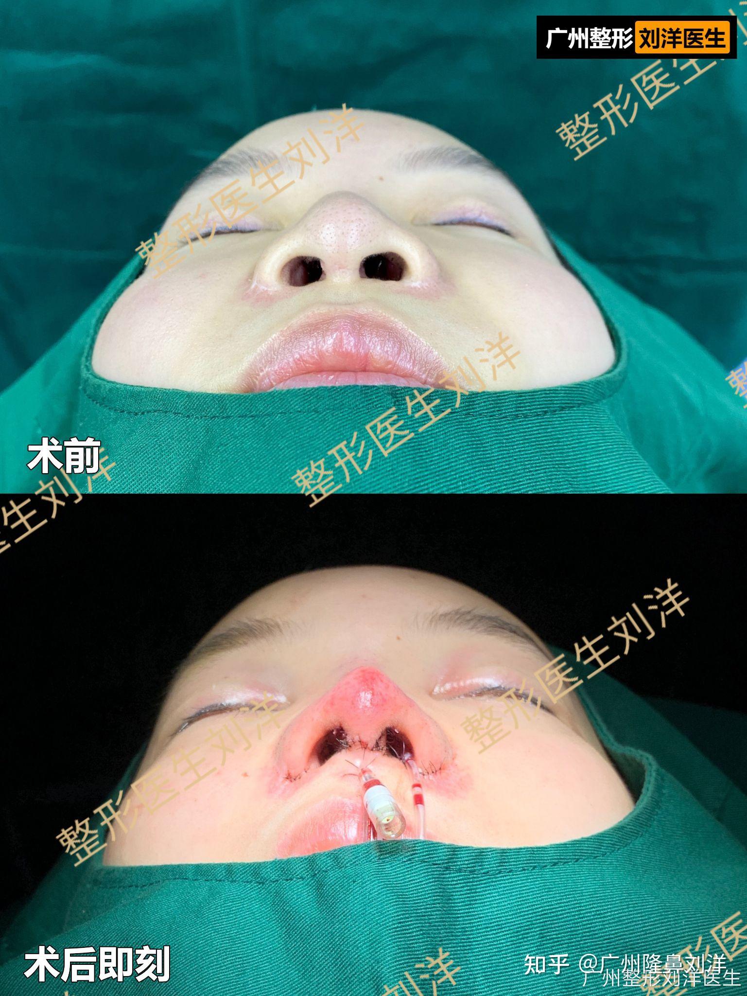 我的鼻子是蒜头鼻,鼻翼宽,而且鼻头大,还像猪鼻子. - 知乎