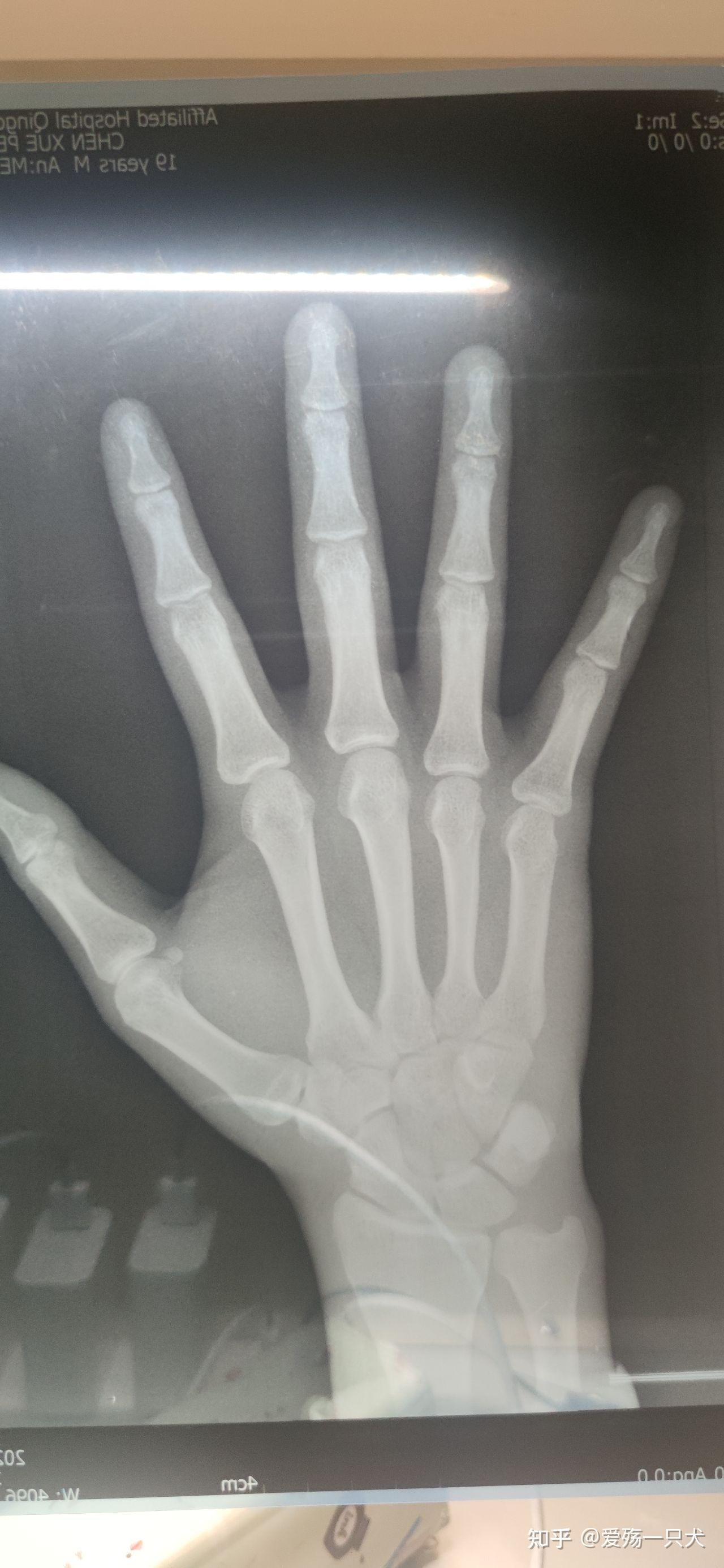 我不知道我的骨骼线是不是半闭合还是完全闭合我还能长吗