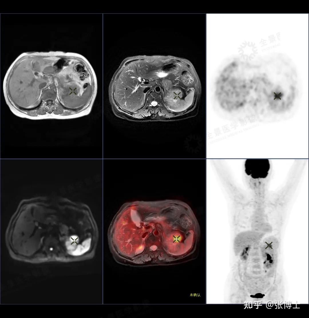 PET/CT-MR在肾癌诊断中的价值 - 知乎