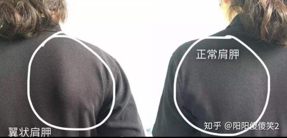 我是女生有翼状肩胛骨要激活前锯肌的话每天练仰卧哑铃上拉有用吗