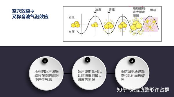 维密体雕吸脂是什么 效果怎么样 知乎