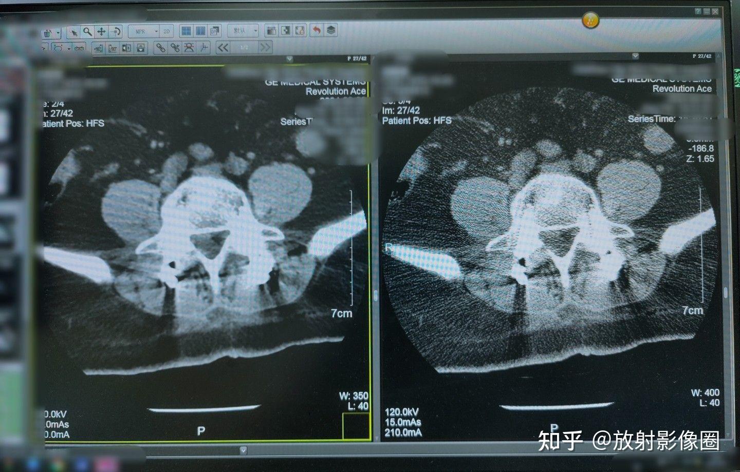 原来CT有自带的美图功能?「CT扫描技巧专栏」之淡化金属伪影 - 知乎