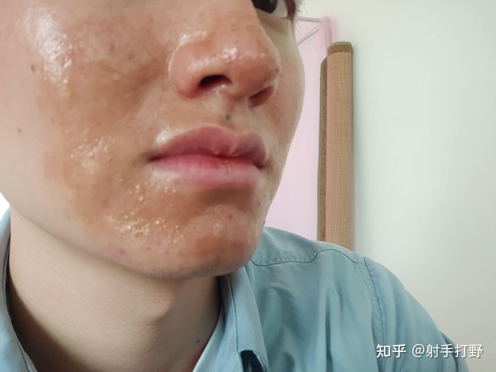 仅以此文记录我玫瑰痤疮(酒糟鼻)治疗过程