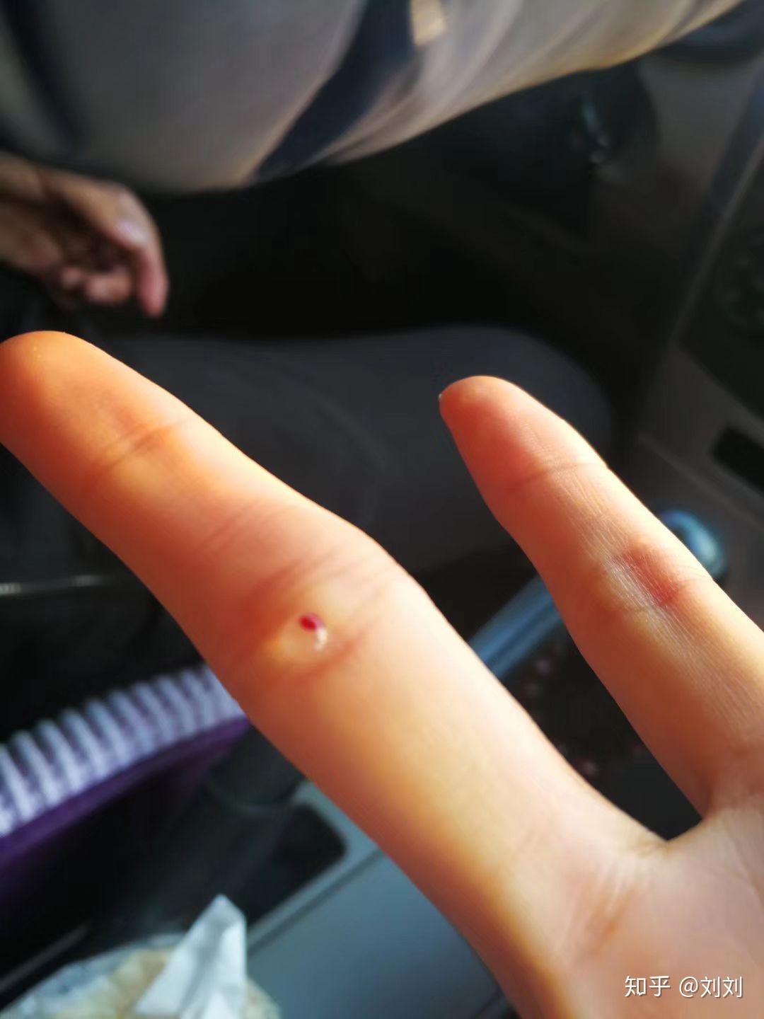 攻心翻到底是一种什么病? - 知乎