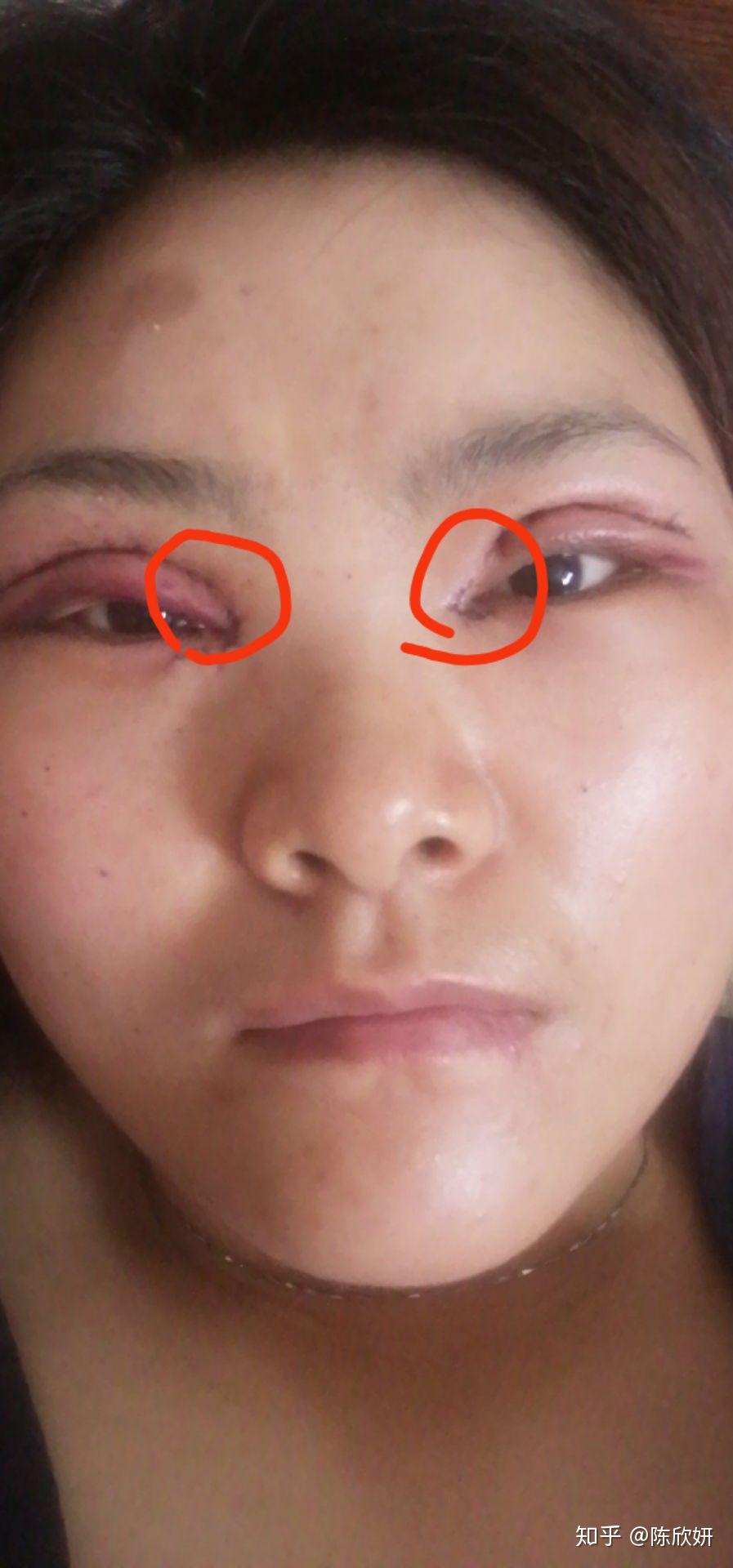 割双眼皮失败是什么样子的