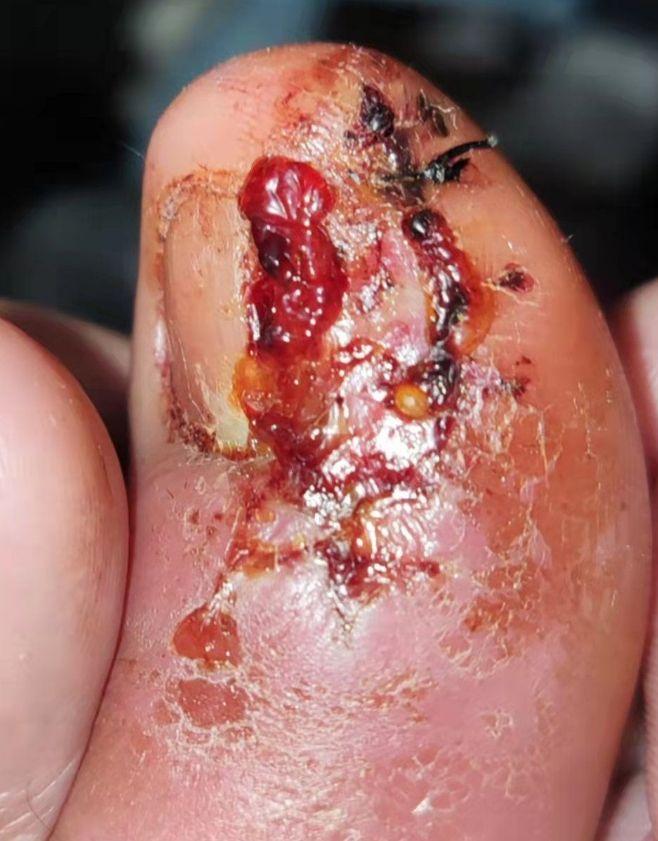 甲沟炎侧切 - 知乎