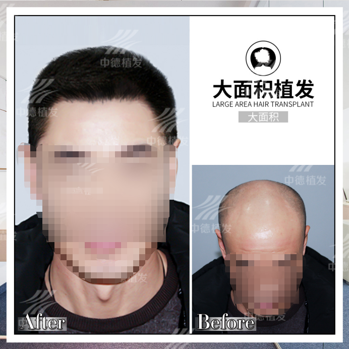 中德植发他说:65岁到40岁,也就半年时间 - 知乎