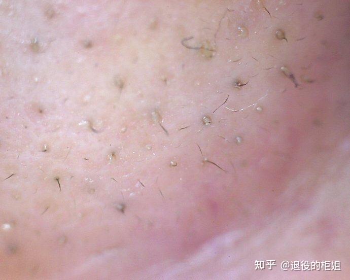 毳毛黑头怎么去呀? - 知乎