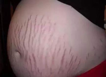 产后西瓜皮肚子还有救吗