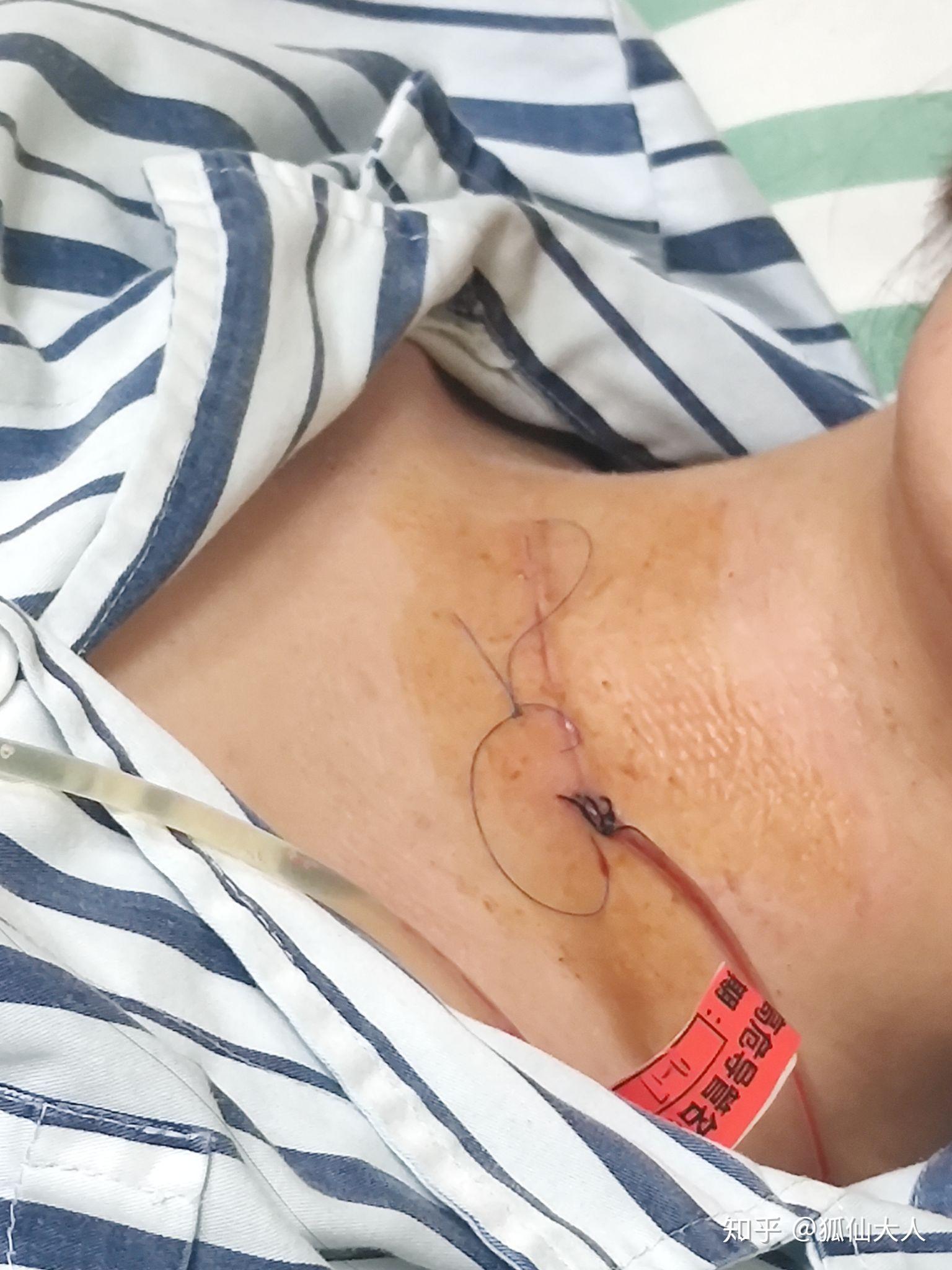 甲状腺术后疤痕增生,用什么祛疤膏好一些? - 知乎