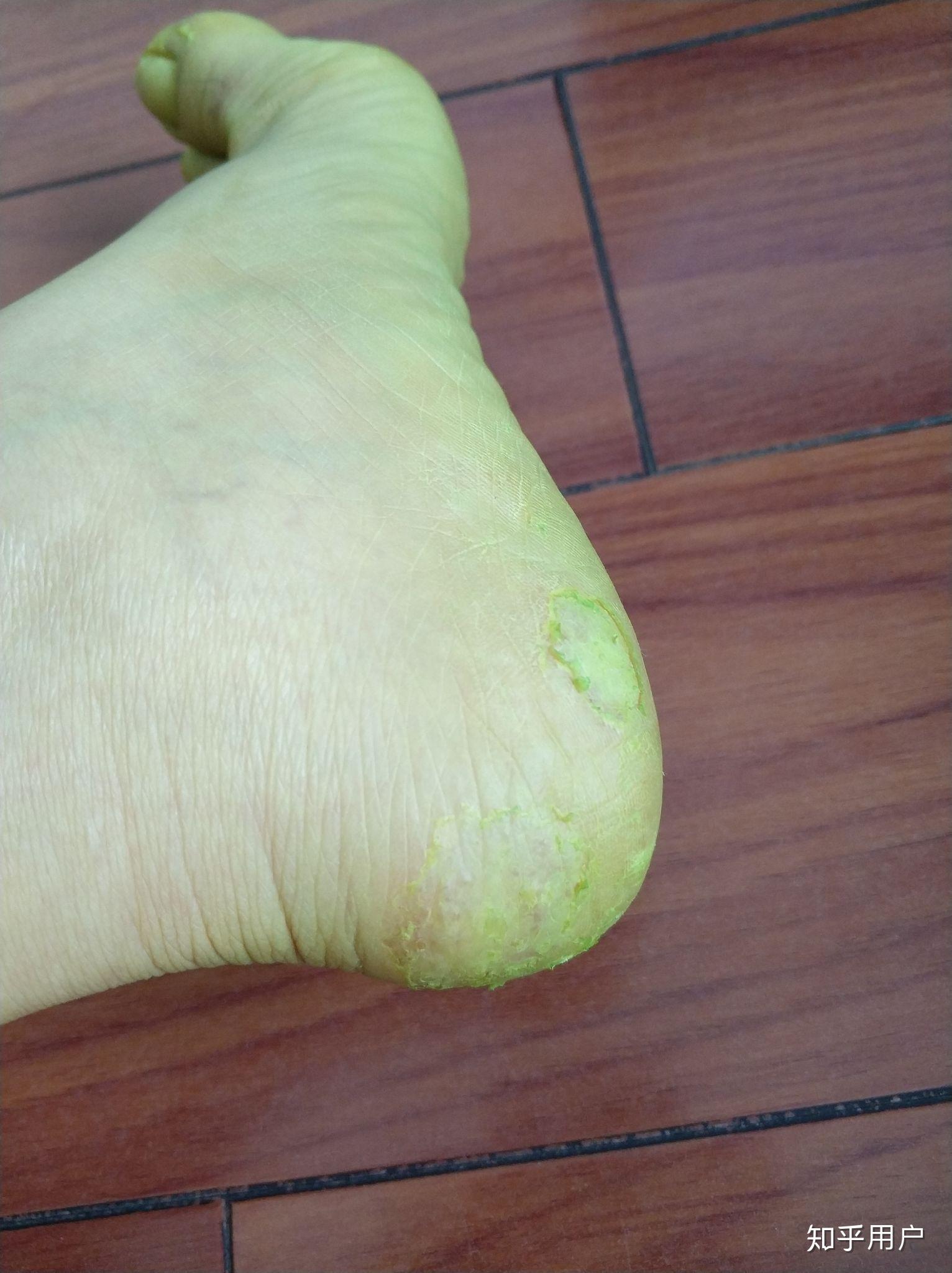 珊瑚癣净管用吗