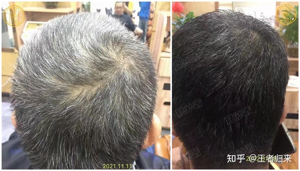 国颐堂养发馆做白转黑有效果吗?有没做过的亲? - 知乎