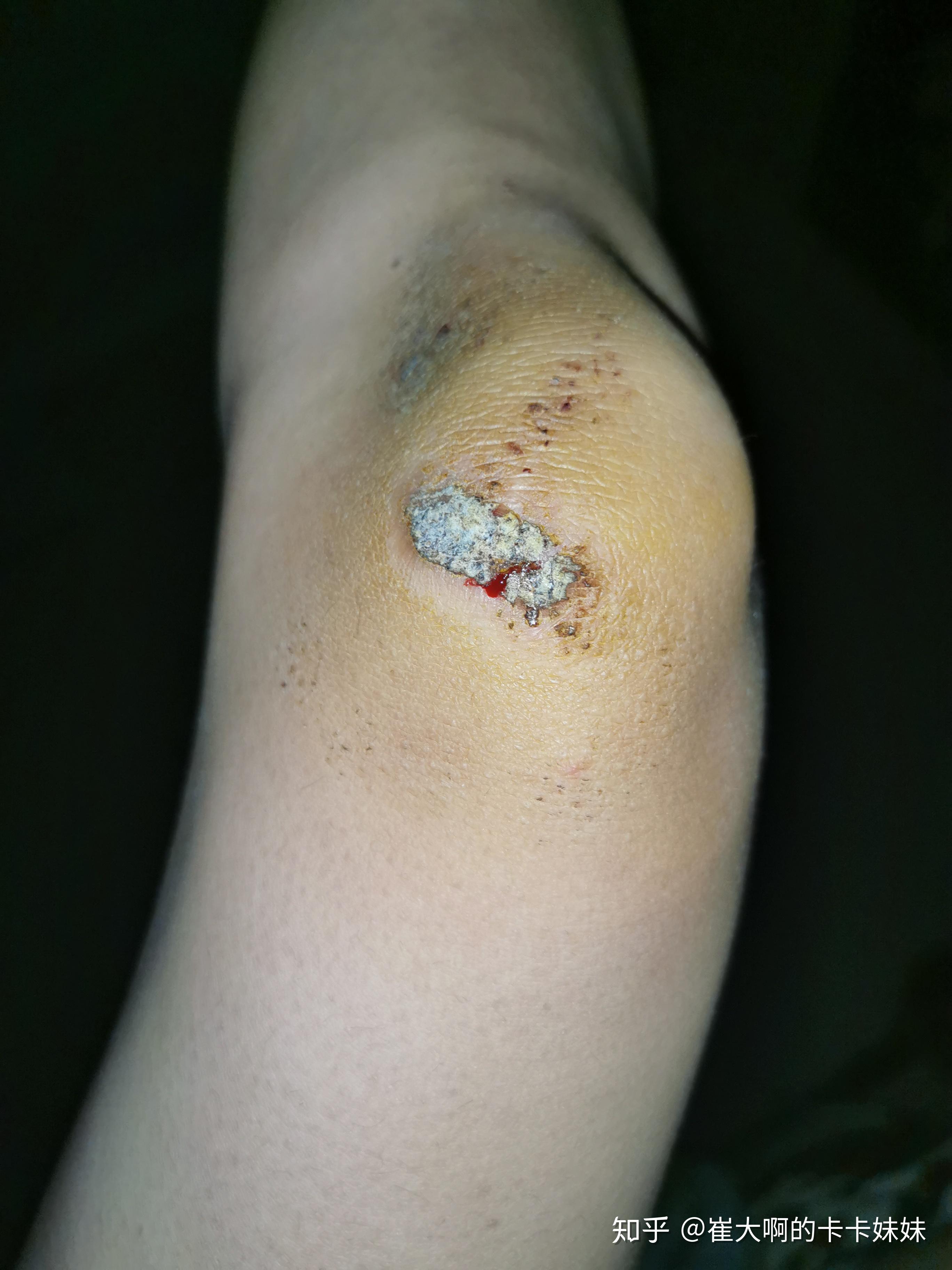 骑车侧翻膝盖摔伤破皮,怎么处理伤口,怎样才能不留疤? - 知乎