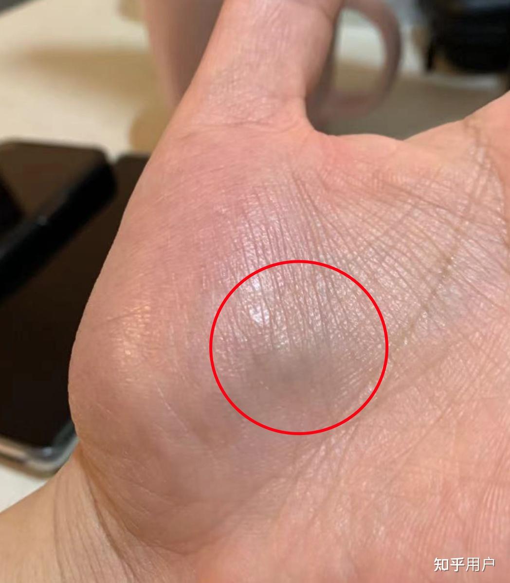 手上的血管很明显,有什么问题吗? - 知乎