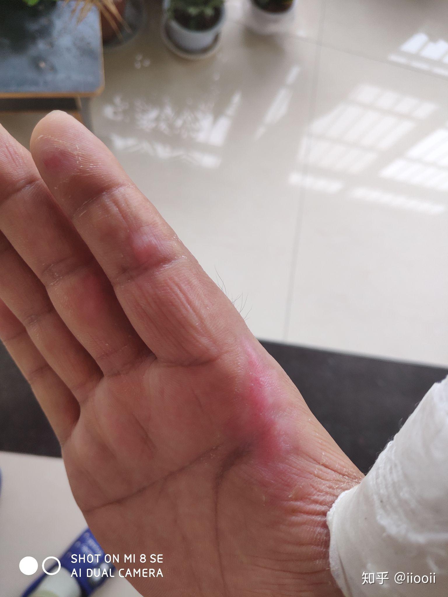 电弧烧伤疤痕增生抗疤治疗