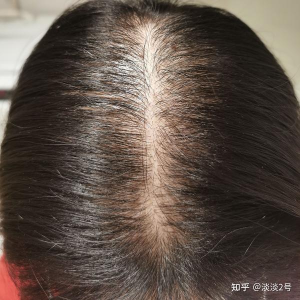 90后老阿姨的生发之路 - 知乎