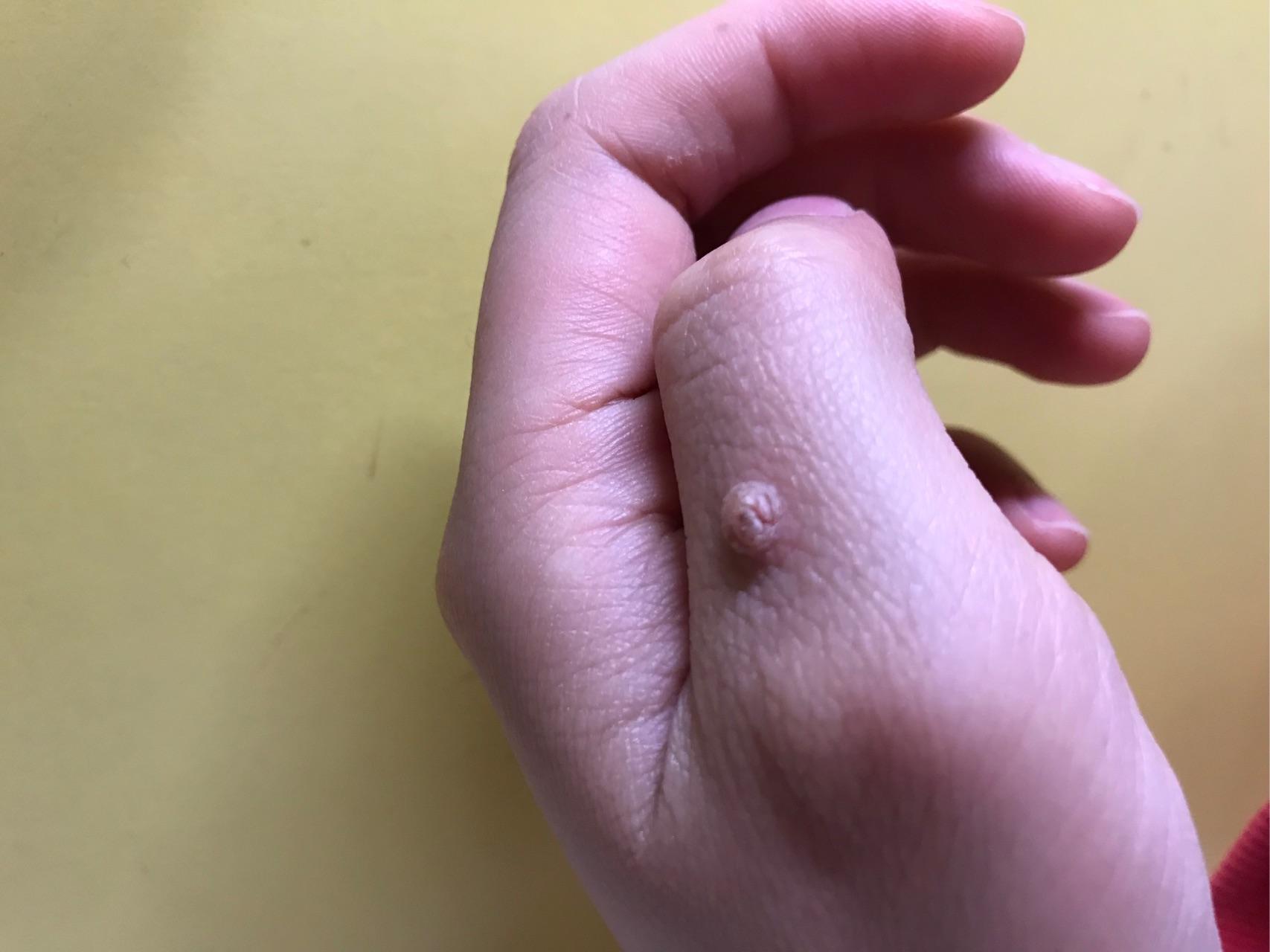 手上长了个小肉球,不知道该肿么办 求大神帮忙! - 知乎