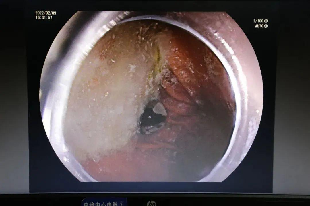 跑到胃里的弹珠用避孕套兜出来从4岁到70岁误吞中招何其多