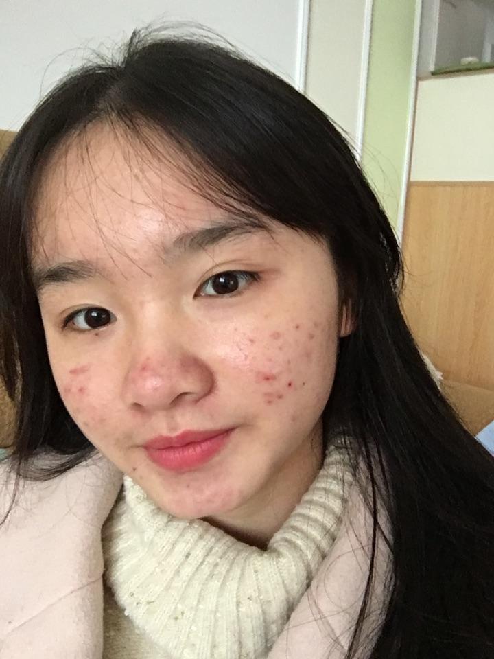 你脸长痘痘的时候是用什么方法使痘痘完全好了呢? - 知乎