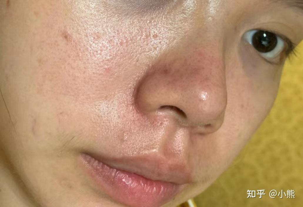 刷酸,荷荷巴油都尝试过,但是黑头还是很多,有没有真正有效适合学生党