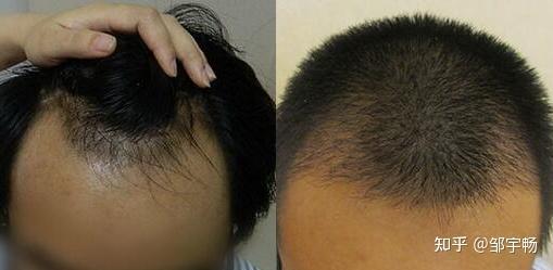 我这种的发际线严重吗谢谢