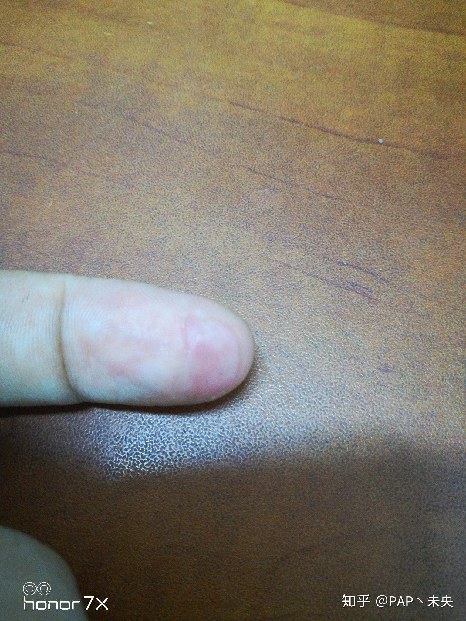 被电烙铁烫伤是一种什么样的体验怎么处理不易留疤