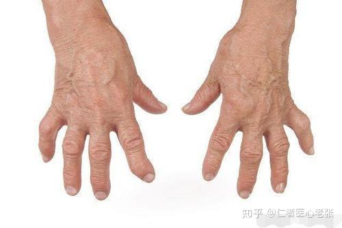 类风湿危害严重人均治疗费用超过15万有40以上的患者没有就医