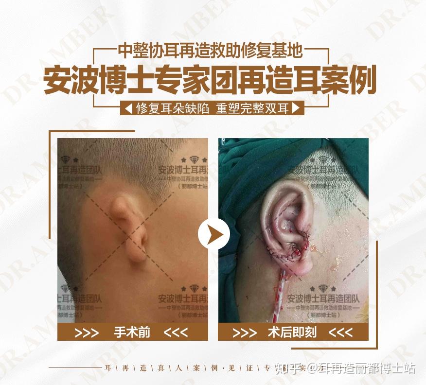 一年当中那个季节最适合做耳再造手术