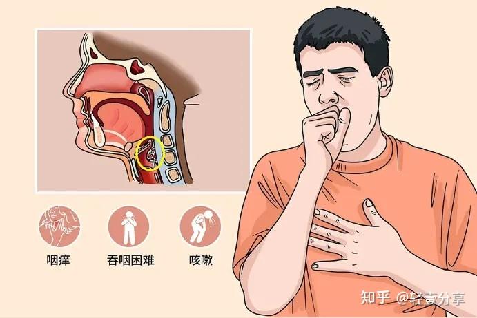 中国超过50%的人患有慢性咽炎,慢性咽炎的症状是什么? - 知乎