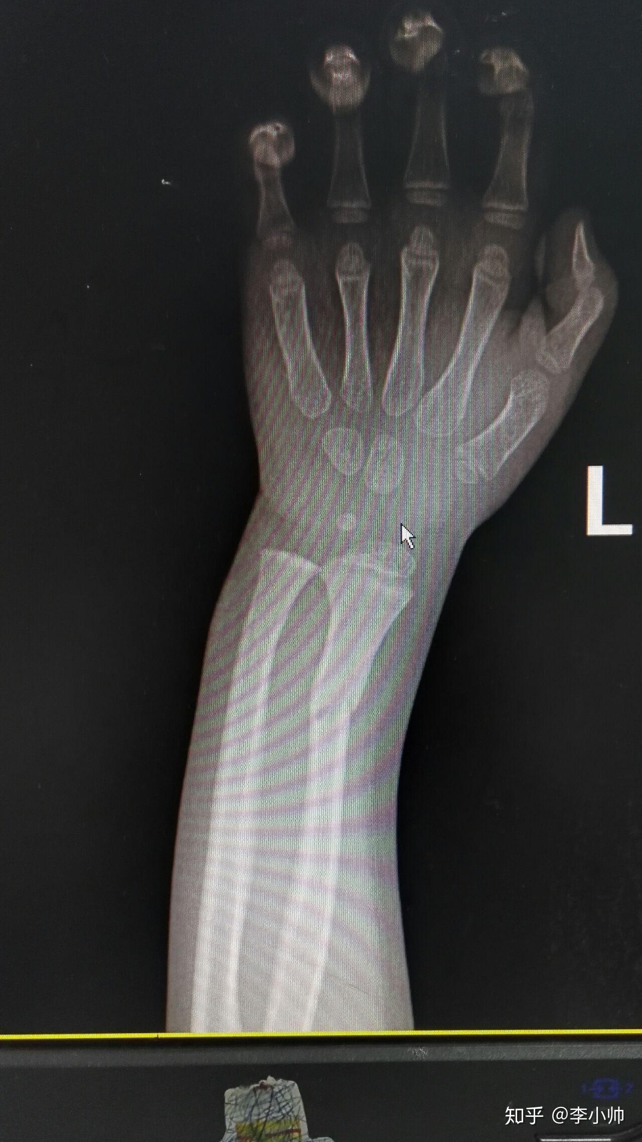 你们单位的四肢骨折传统手法复位能精准到什么程度