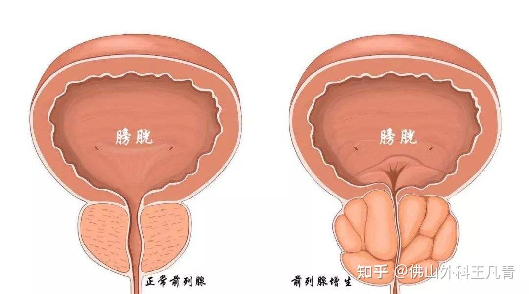 膀胱颈扩张图片