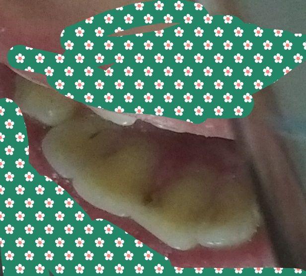 门牙有点龋齿后面烂了个洞牙医说补了容易掉然后把我两个门牙磨小做