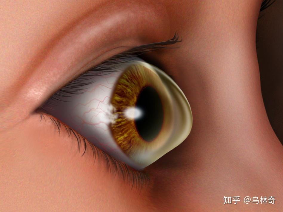 因为遗传性或表观遗传性慢性营养不良或不均衡,造成角膜变薄,晶状体