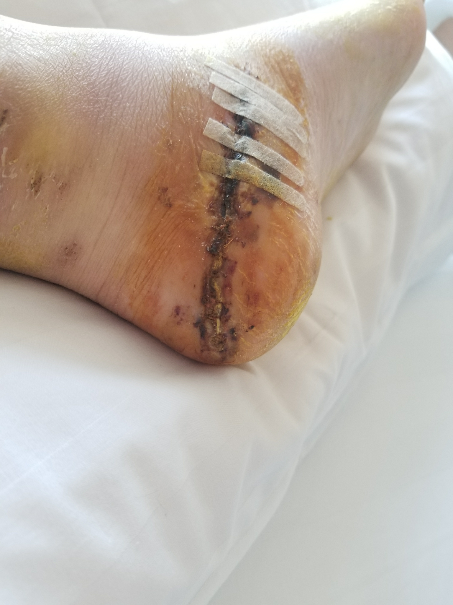 缝针和拆线可怕吗?疼吗?你们当时怕吗? - 知乎