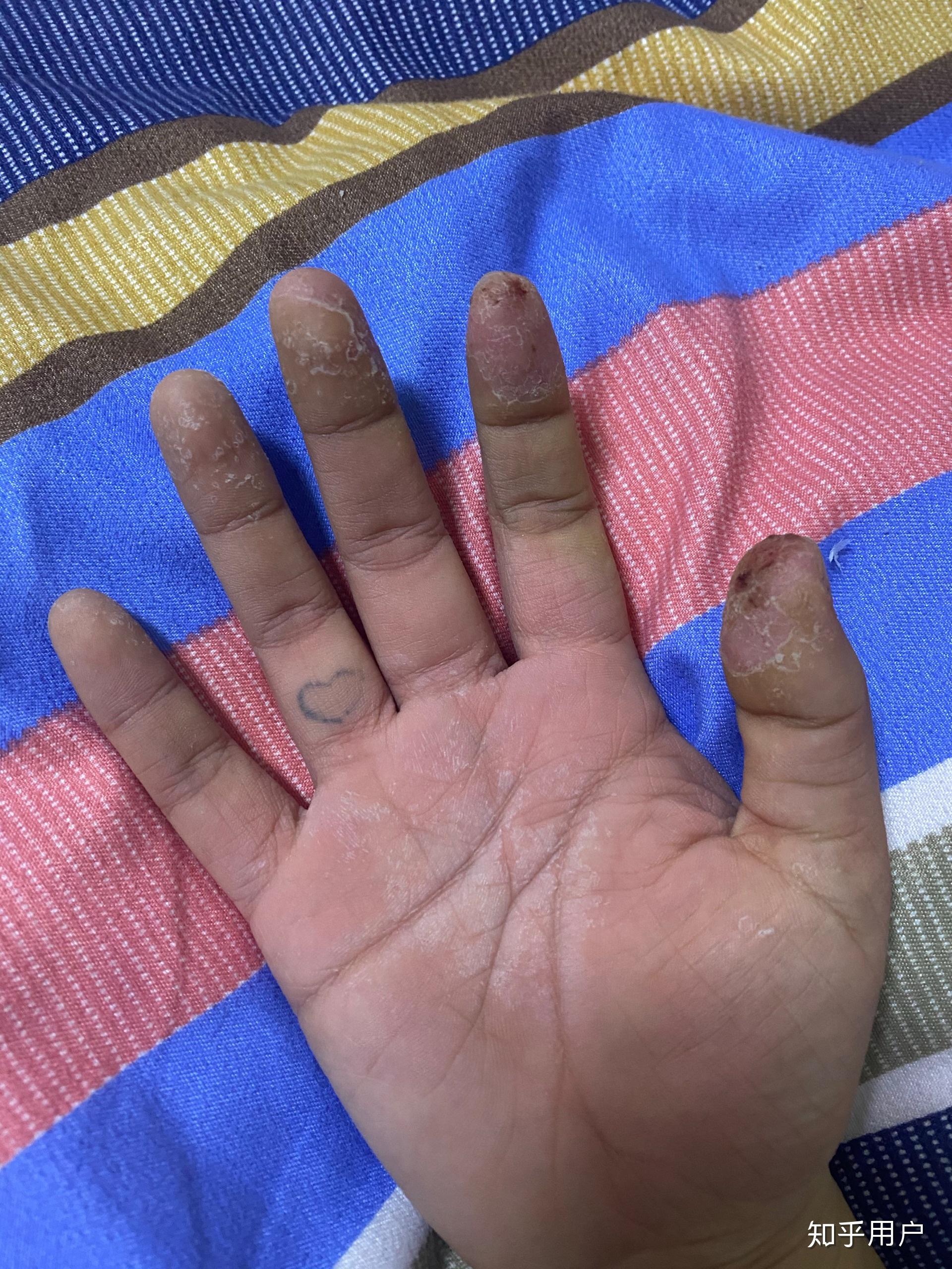 我是做美甲工作的,最近手开始过敏,起初是小水泡后来脱皮到溃烂,看