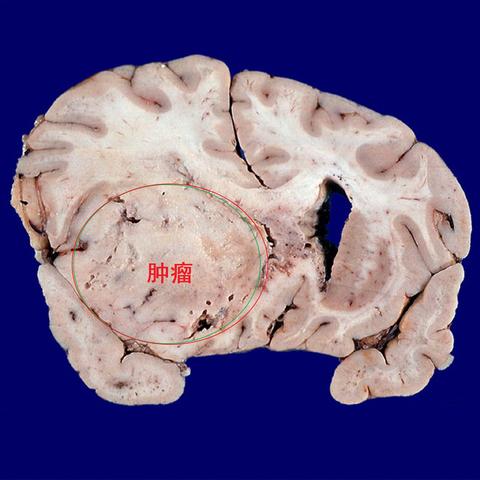 颅内肿瘤