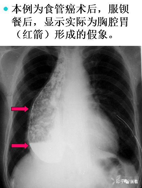 在心影外12客服定向思维辨真相陈旧性肺结核导致的胸廓塌陷?