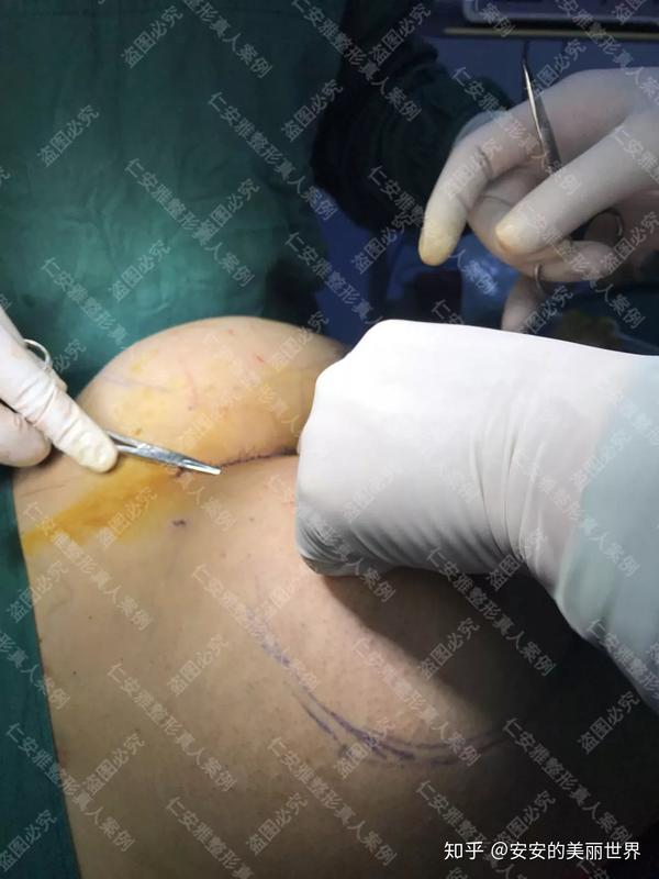 假体丰臀后的小姐姐 手感柔韧自实挺翘 臀部自然圆润性感