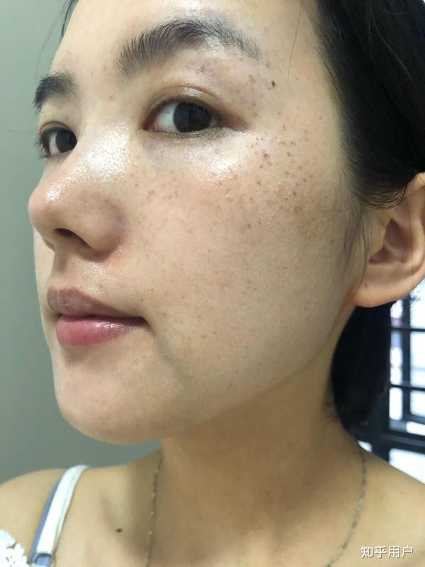 如何才能真正祛斑淡斑？有哪些好用的祛斑方法？