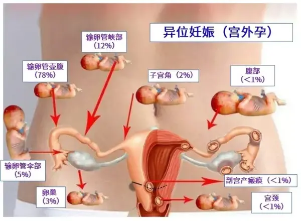 试管婴儿会不会发生宫外孕 知乎