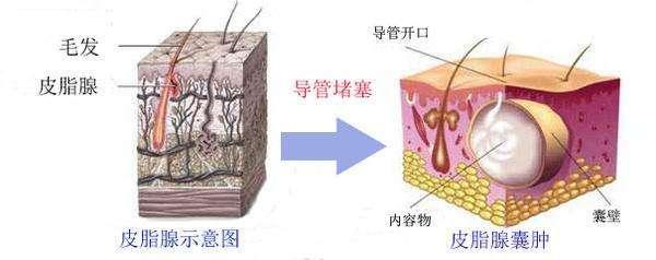 毛囊炎疖痈皮脂腺囊肿怎么区分