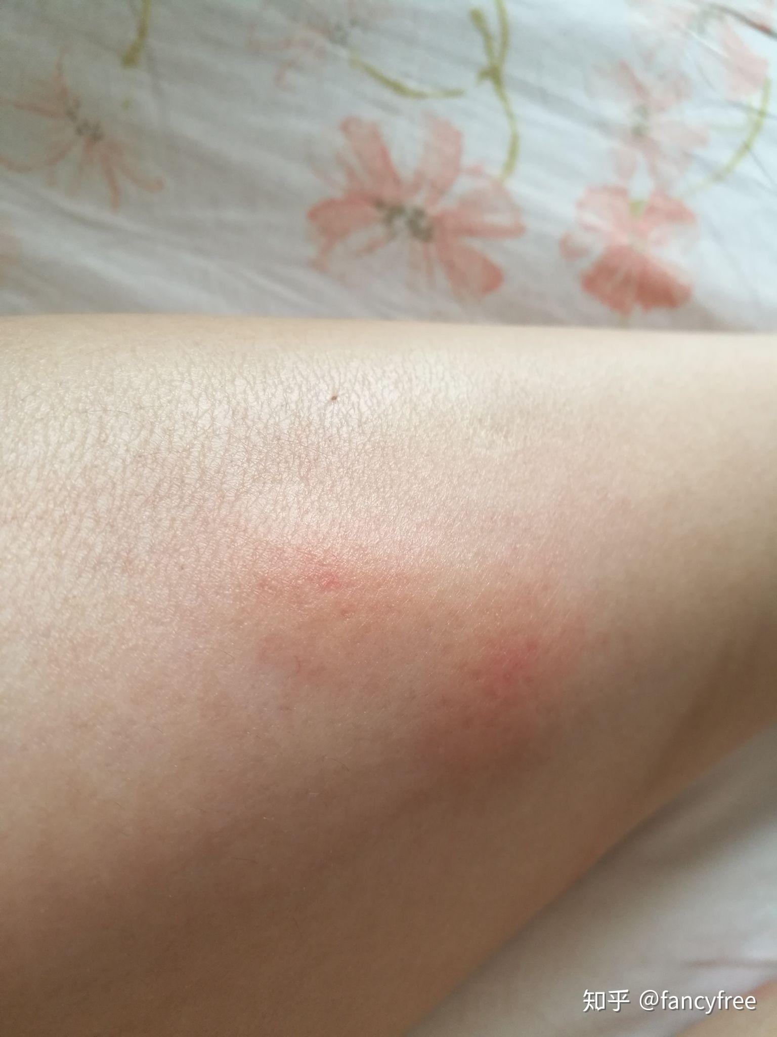 被蚊子咬后身上起一又红又大的包请问抹什么才能止痒消包总感觉现在的