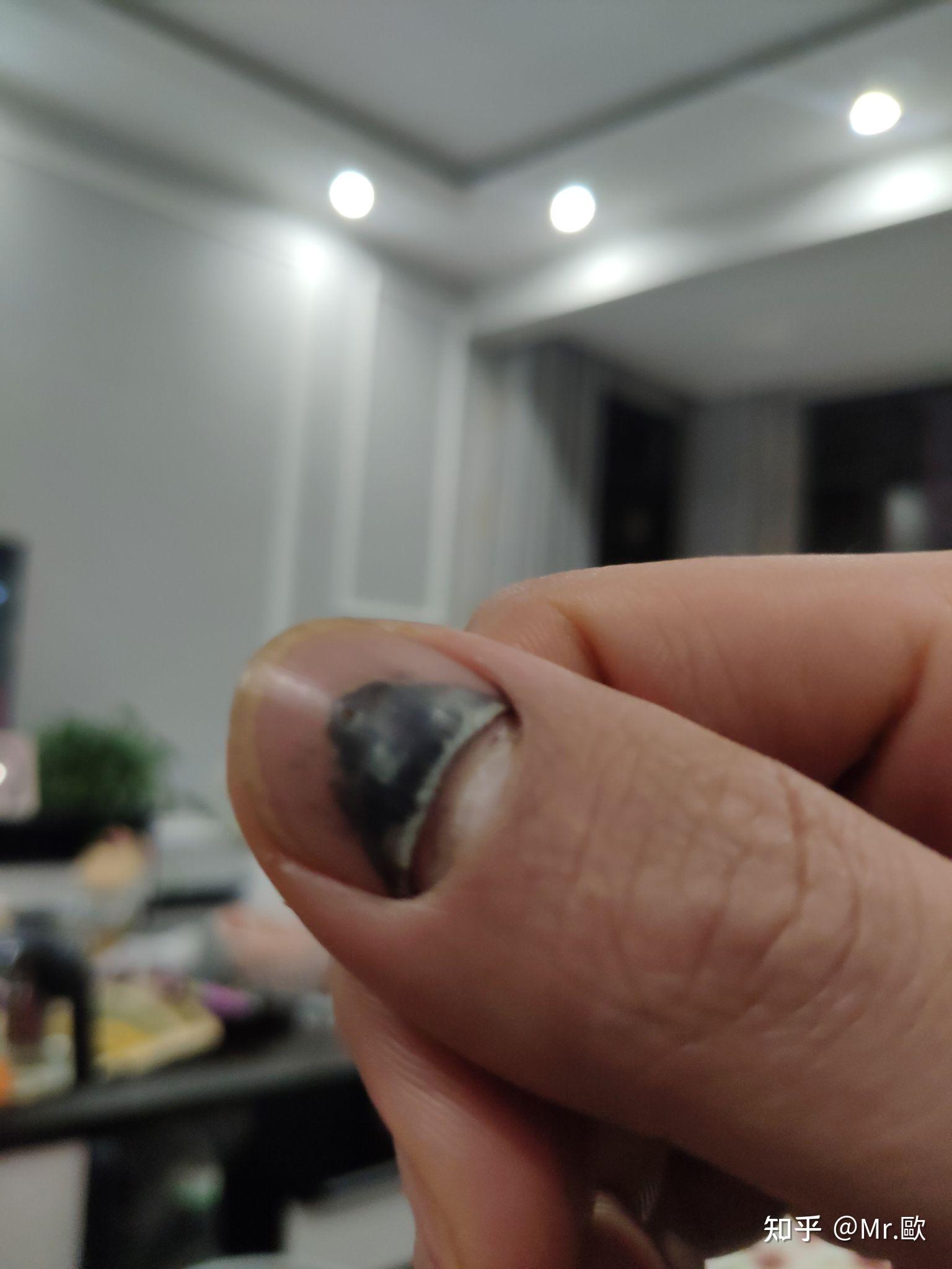 手指甲被夹到过了一段时间有黑色的淤血怎么处理