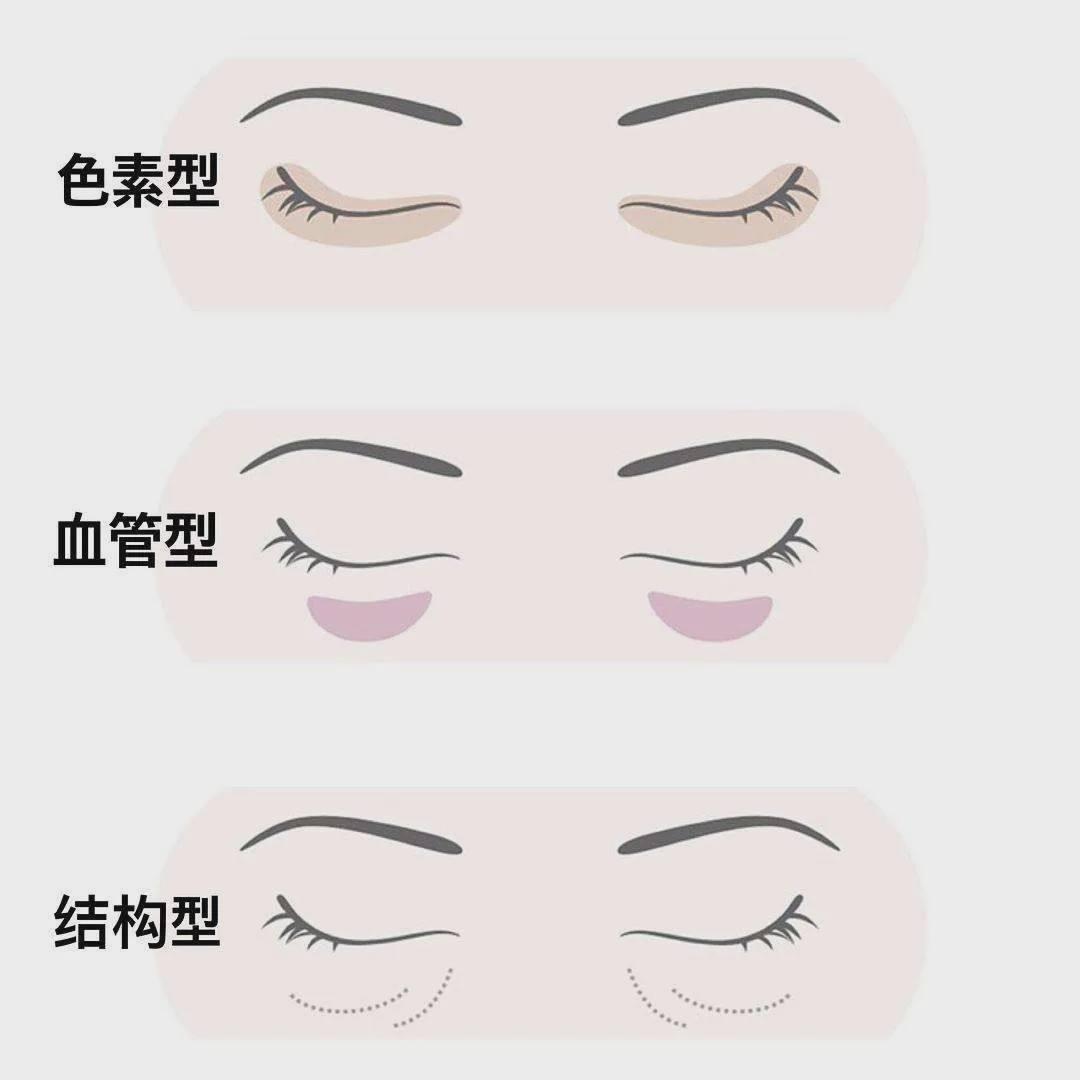 3種黑眼圈顏色的秘密，日本專家教你對症消除！ | 蕃新聞