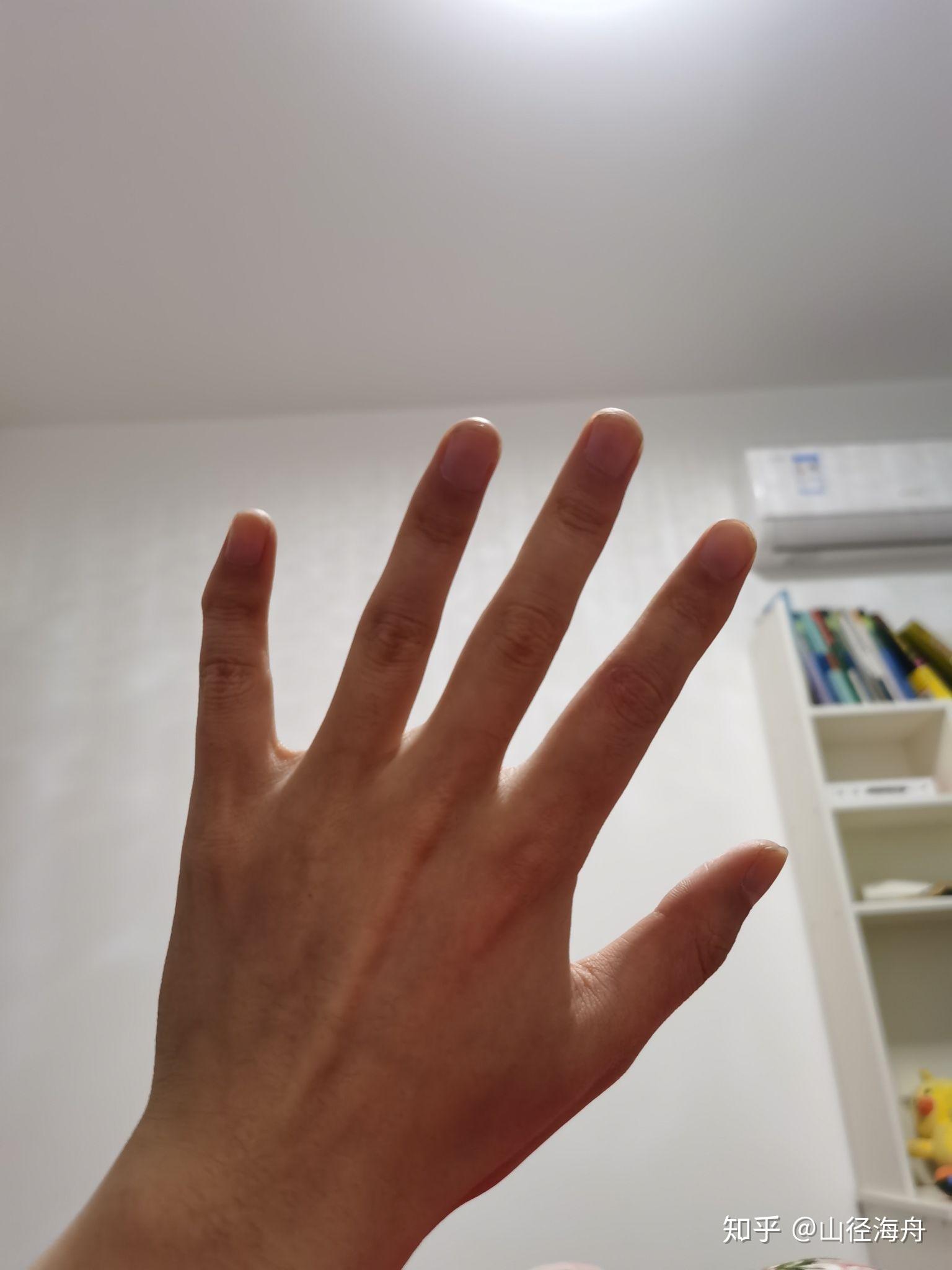 有没有天生小拇指向外弯曲的朋友
