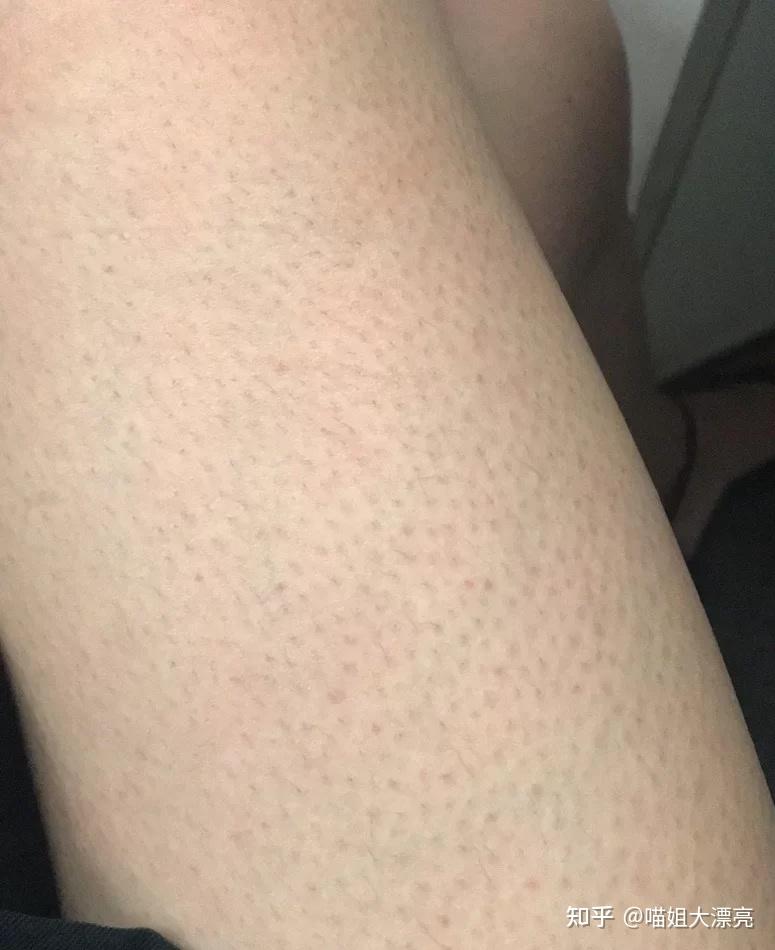 鸡皮肤突然变大了怎么办(鸡皮肤突然变大了怎么办啊)