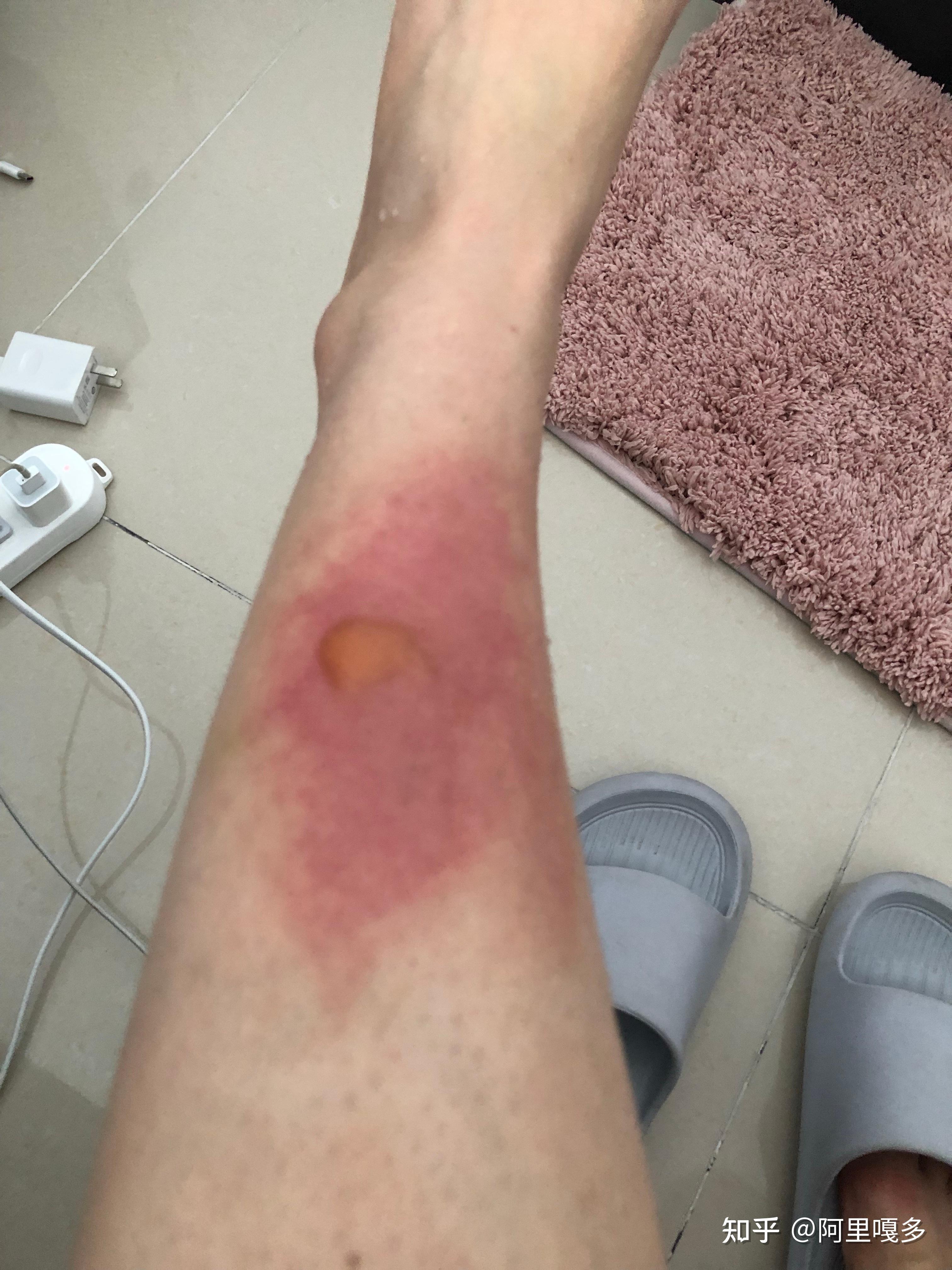 被开水烫伤过了三四天突然皮肤发红了会不会留疤